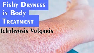 Ichthyosis Vulgaris Fishy Dryness Explained by Dr Rohit Goel [upl. by Harutek756]