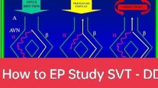 SVT approach in EP AVNRT ablation AVNRT ablation avnodalreentrytachycardia EPstudy [upl. by Olifoet]