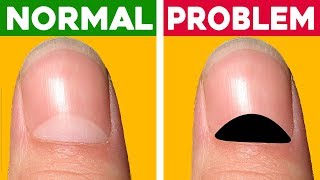 13 Health Problems Your Nails Warn You About amp Why Changes Your Lunula Color [upl. by Janetta]