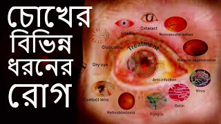 চোখের বিভিন্ন ধরনের রোগ এবং তাদের লক্ষণ16 type of Eye Diseases [upl. by Malita153]