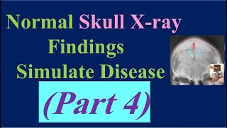 Normal Skull Xray Findings Simulate Disease part 4 Cranial Hyperostosis [upl. by Proudfoot]