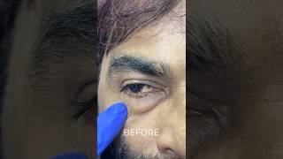 Get rid of undereye bags  Dr Varun Nambiar blepharoplastysurgery undereyebags cosmeticsurgery [upl. by Elokin240]