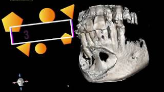 Mandibular Cyst [upl. by Niowtna]