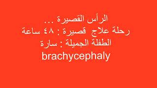 Brachycephaly correction [upl. by Lee]