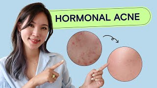 How To Treat Hormonal Acne  Acne School EP03 Health [upl. by Anair]