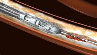 Atherectomy with Jetstream from Boston Scientific  CardioVisual [upl. by Collimore]