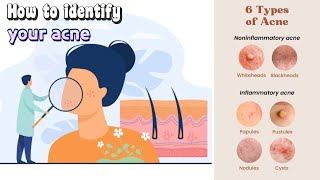 how to get rid of acne  clearing acne ultimate treatment guide acne treatment [upl. by Ainsworth]