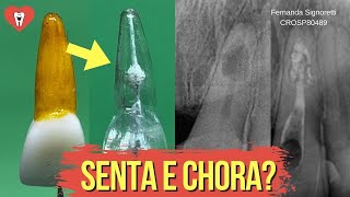 ENDODONTIA EM REABSORÇÃO INTERNA  PASSO A PASSO  Endolovers [upl. by Newfeld182]