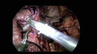 SS07 Best of Video V027 LAPAROSCOPIC GASTRECTOMY FOR GASTRIC CANCER [upl. by Sedberry]