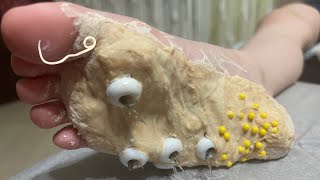 Removal of parasites from the holes on the sole of the foot [upl. by Marozik]