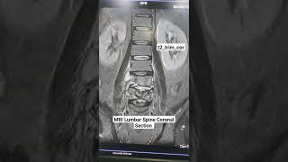 MRI Lumbar Spine Coronal Section t2trimcor Sequence Planning for beginners [upl. by Alonzo867]