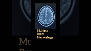 Multiple brain hemorrhage [upl. by Gastineau217]