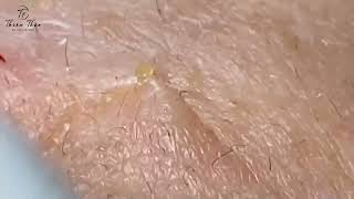 Forehead blackhead monster  Incredible Blackhead Removal  Mesmerizing Pimple Pops 136 [upl. by Olav148]