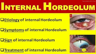 internal hordeolum [upl. by Tinor364]