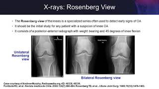 Knee Osteoarthritis Examining the Evidence on SingleInjection Hyaluronic Acid [upl. by Harlamert946]