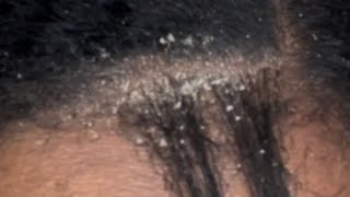 Dandruff Scratching Ashy Flaky Scalp [upl. by Adala]