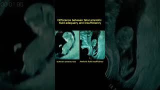 Difference between fetal amniotic fluid and insufficiency ultrasound pregnancy shorts [upl. by Thirzi171]