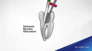 Hydraulic Bonded Obturation [upl. by Adnawak]