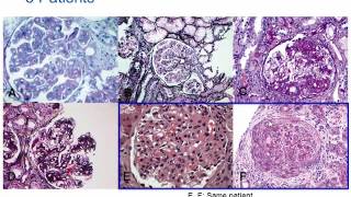 Understanding Membranoproliferative Glomerulonephritis Part 2 Hot Topic [upl. by Anitroc]