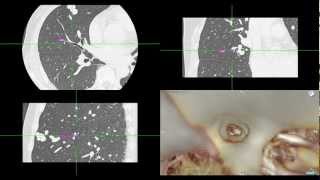 Virtual Bronchoscopy with navigation [upl. by Chassin]