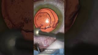 Curing post PRK Recurrent Erosions with diamond bur cornea [upl. by Wsan]