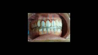 gingivectomyoralsurgeryperiodontalsurgery [upl. by Eceeryt]