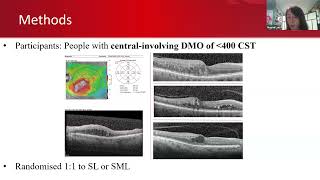 CME  Update on Medical Retina Talks by Dr Mahesh G Dr Noemi Lois [upl. by Harve]