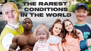 10 Of The Rarest Conditions In The World  BORN DIFFERENT [upl. by Forelli]