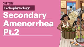 Secondary Amenorrhea Pathophysiology Part 2  Sketchy Medical  USMLE Step 1 [upl. by Tolland]