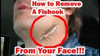 Hook Removal From Skin How To Remove a Large Fish Hook From Your Face or Ear [upl. by Ofloda]