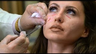 Juvederm Under Eye Filler Procedure  NJ Plastic Surgeon Dr Asaadi [upl. by Aksel]