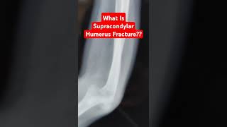 What Is Supracondylar Humerus Fracture Dr Sai Chandra MBBS DNB Ortho FIAS South Korea FIJR Germany [upl. by Roleat]