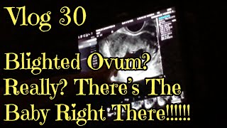 Vlog 30 Blighted Ovum Really There’s The Baby Right There Oct 3 2014 [upl. by Waddle]