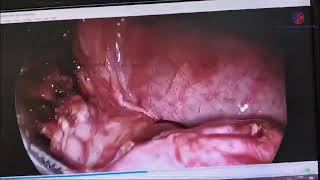 laproscopic removal of Tubo ovarian mass [upl. by Annat]