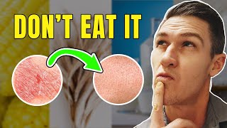 Top 5 Foods to Remove if you Have Psoriasis [upl. by Zerlina]