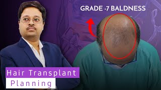 Grade 7 Baldness  Hair Transplant Planning by Dr Jayanta Bain Plastic Surgeon [upl. by Yenffit]