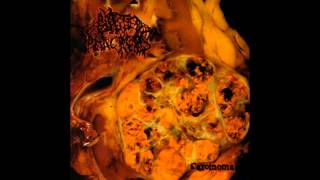 Blasted Pancreas  Carcinoma FULL ALBUM 2011  Pathological Goregrind [upl. by Alastair]