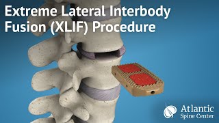 Extreme Lateral Interbody FusionXLIF Procedure [upl. by Nhaj886]