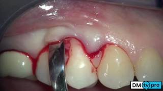 Single gingival recession treatment with Mucograft matrix [upl. by Aetnahs819]