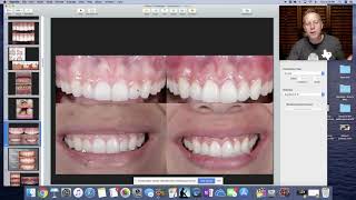 Gingivectomy vs Crown Lengthening Education for dental staff [upl. by Aivat]