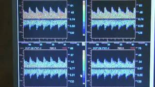 Multigon TOC 2M Transcranial Doppler [upl. by Gnilsia975]