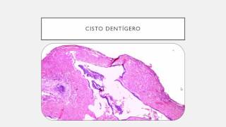 10  CISTOS ODONTOGÊNICOS [upl. by Armington]