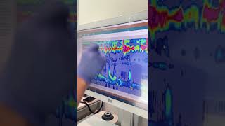 Esophageal Manometry Test with Austin Gastro November 2024 [upl. by Ykvir]