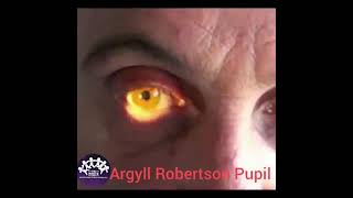 ARGYLL ROBERTSON PUPIL [upl. by Ainniz]