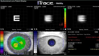 Ray Tracing Aberrometry  Dr Saud Javed [upl. by Novrej]