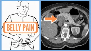 Warning Signs of Pancreatic Cancer [upl. by Yeznil]