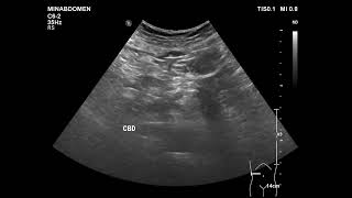 acalculous cholecystitis [upl. by Adnil]