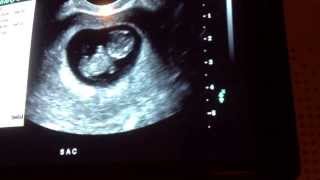 9 weeks 6 days ultrasound  baby moves [upl. by Sitnerp]