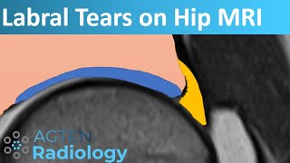 Labral Tears on Hip MRI [upl. by Sanger]