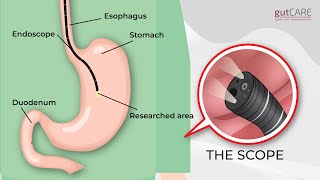 Preparing For Your Gastroscopy OGD  GUTCARE [upl. by Leverett]